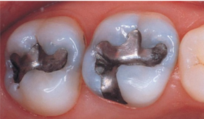 Amalgam